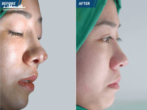 top-5-dia-chi-sua-mui-hong-tphcm-uy-tin-bac-si-gioi-1