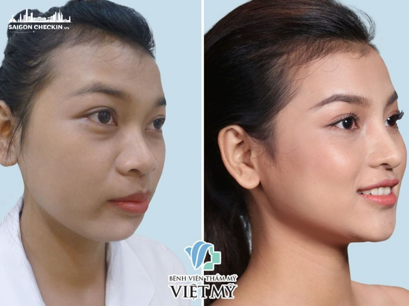 top-5-dia-chi-sua-mui-hong-tphcm-uy-tin-bac-si-gioi-2