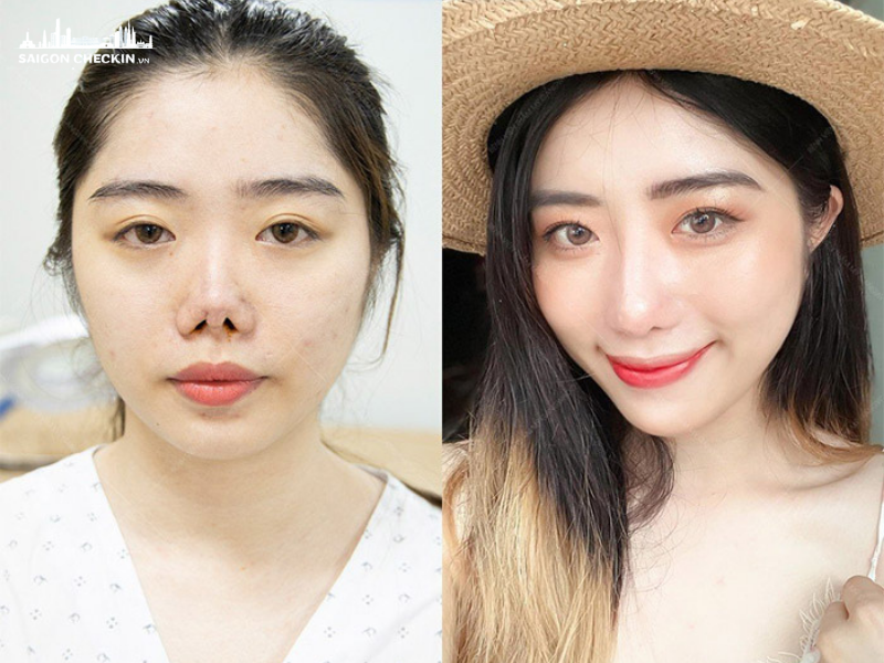 top-5-dia-chi-sua-mui-hong-tphcm-uy-tin-bac-si-gioi-3