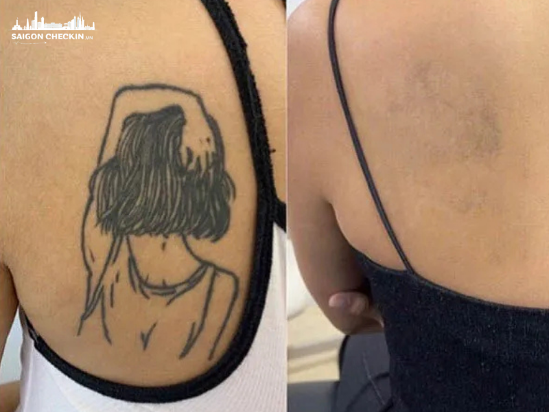 top-5-dia-chi-xoa-hinh-xam-tphcm-an-toan-khong-seo-uy-tin-4