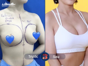 top-benh-vien-tham-my-nang-nguc-tphcm-an-toan-khong-dau-dep-tu-nhien-1