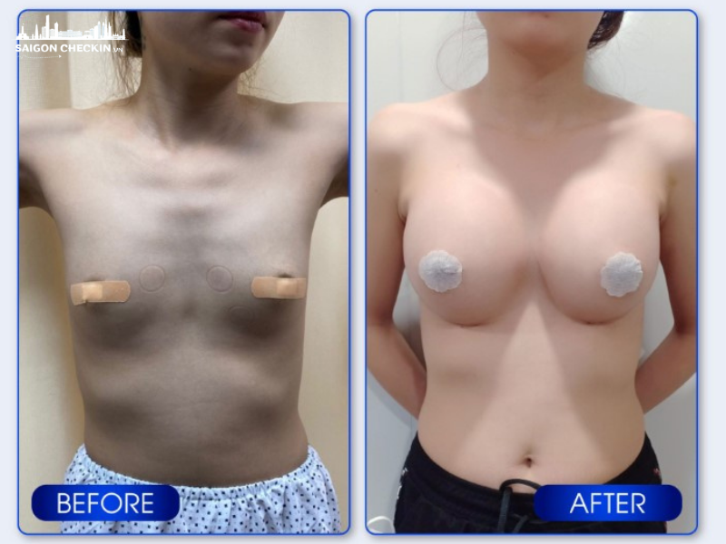 top-benh-vien-tham-my-nang-nguc-tphcm-an-toan-khong-dau-dep-tu-nhien-3