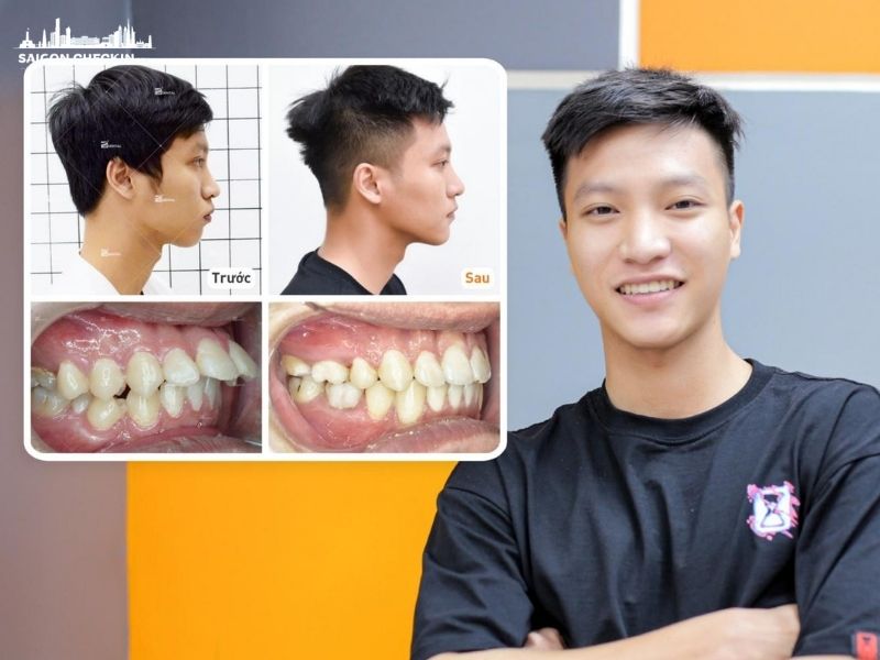 top-dia-chi-nieng-rang-sinh-vien-tphcm-uy-tin-gia-re-tra-gop-0-lai-suat-1