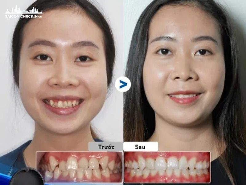 top-dia-chi-nieng-rang-sinh-vien-tphcm-uy-tin-gia-re-tra-gop-0-lai-suat-4