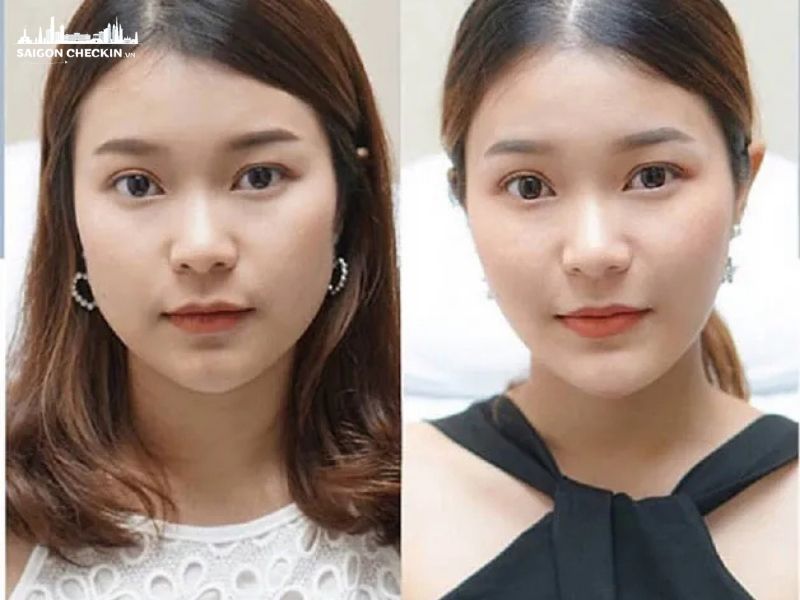 top-dia-chi-tiem-botox-uy-tin-tphcm-an-toan-chinh-hang-3..