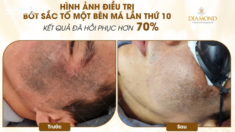 Thẩm mỹ công nghệ cao Diamond