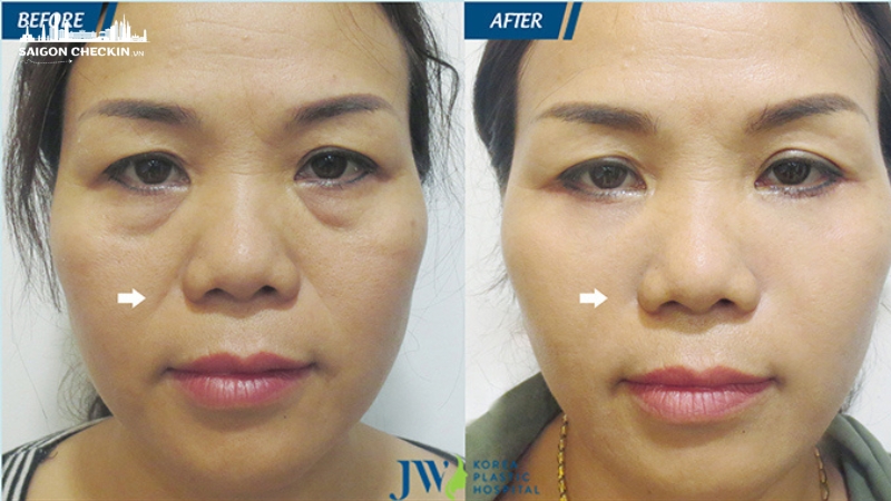 Bệnh viện Thẩm mỹ JW Hàn Quốc – ứng dụng công nghệ trẻ hóa da Hifu