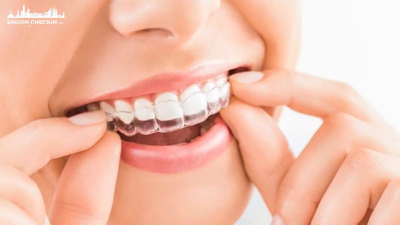 top-nha-khoa-nieng-rang-invisalign-tphcm-1