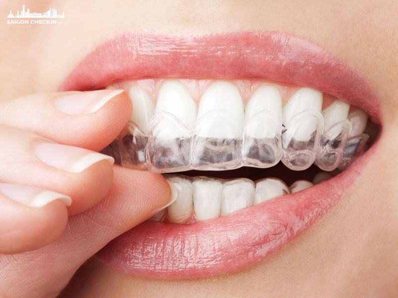 top-nha-khoa-nieng-rang-invisalign-tphcm-3