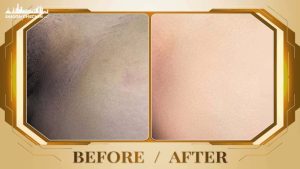 top-spa-xoa-tham-vung-bikini-tphcm-an-toan-khong-dau-3