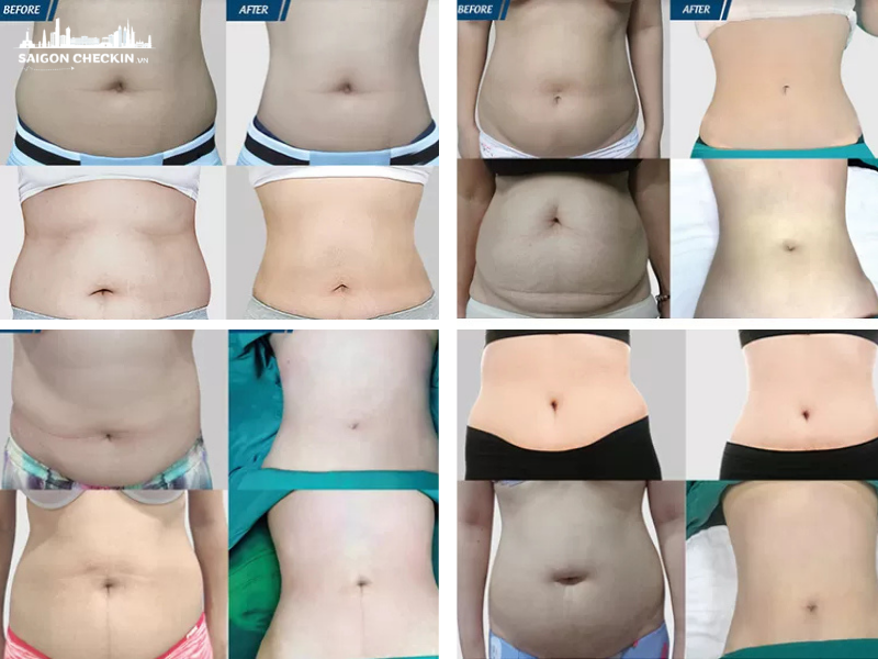 top-tham-my-vien-hut-mo-bung-tphcm-an-toan-uy-tin-bao-hanh-lau-dai-3