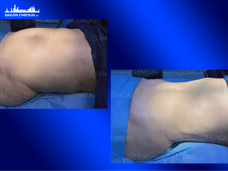 top-tham-my-vien-hut-mo-bung-tphcm-an-toan-uy-tin-bao-hanh-lau-dai-5