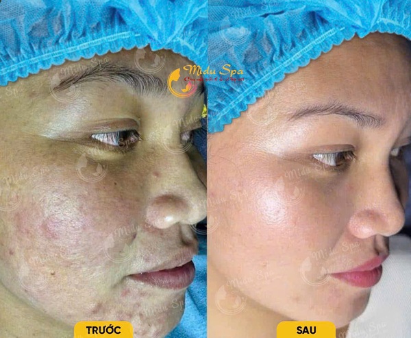 danh-sach-spa-tri-nam-tan-nhang-thu-duc-uy-tin-cong-nghe-cao-hieu-qua-ro-ret-1
