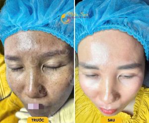 danh-sach-spa-tri-nam-tan-nhang-thu-duc-uy-tin-cong-nghe-cao-hieu-qua-ro-ret-2