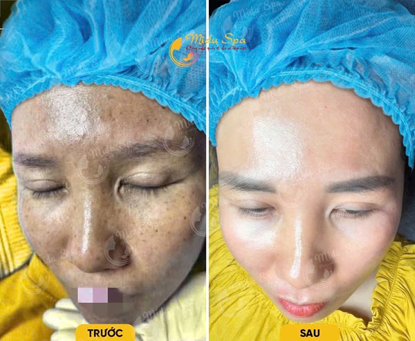 danh-sach-spa-tri-nam-tan-nhang-thu-duc-uy-tin-cong-nghe-cao-hieu-qua-ro-ret-2