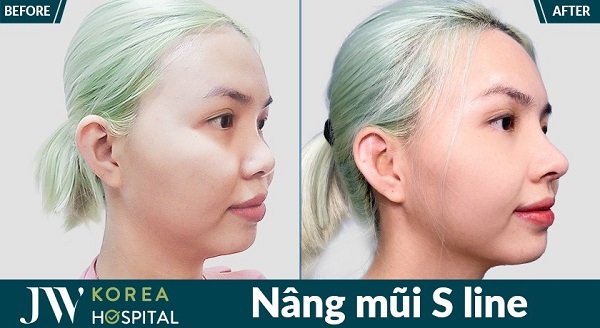 danh-sach-benh-vien-nang-mui-uy-tin-o-tphcm-2