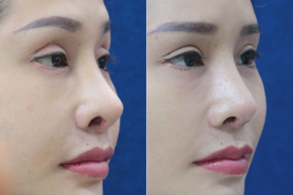 danh-sach-dia-chi-dap-khuyet-ho-canh-mui-o-tphcm-uy-tin-bac-si-gioi-1