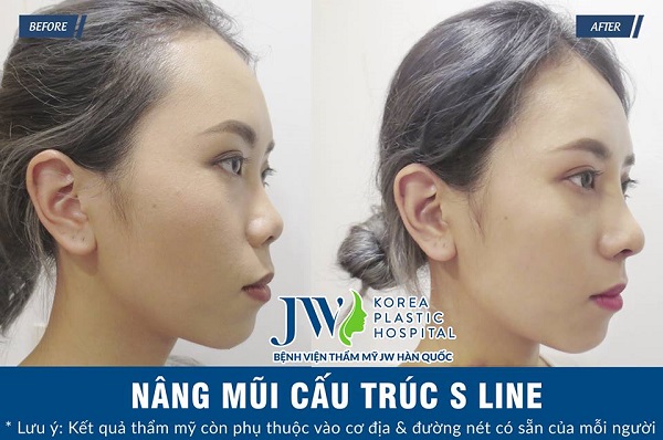 danh-sach-dia-chi-nang-mui-cau-truc-tphcm-uy-tin-dep-an-toan-nen-tham-khao-2