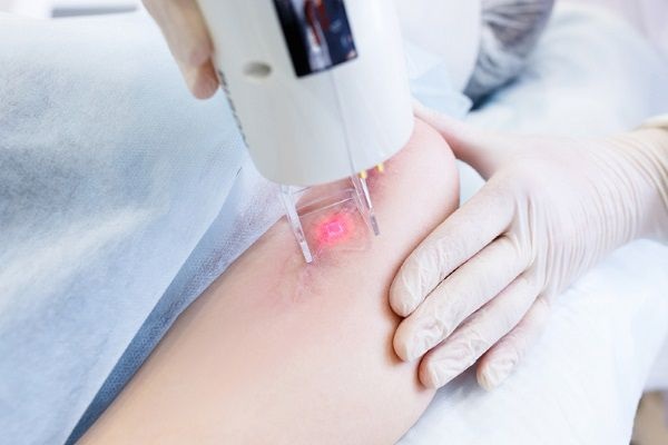 Midu Spa ứng dụng công nghệ Laser CO2 Fractional trong trị thâm body Thủ Đức