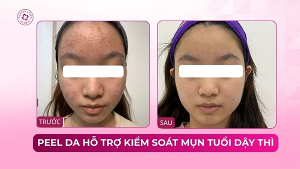 spa-peel-da-phu-nhuan-1