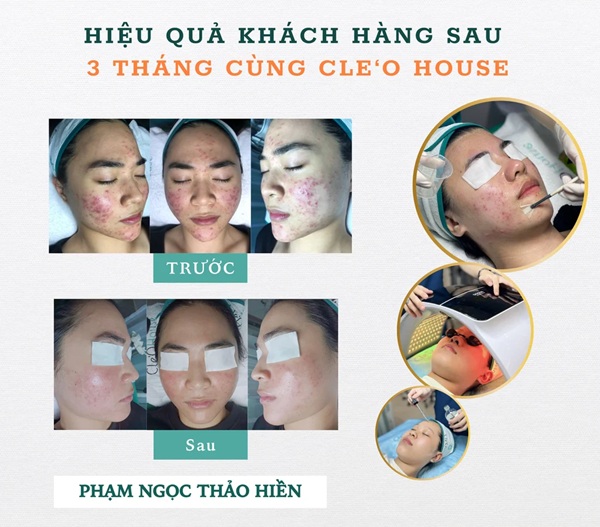 Cle’O House – phù hợp người ưu tiên lấy nhân mụn và ngân sách dễ tiếp cận