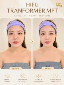 HIFU Ultraformer MPT trẻ hóa da tại Hugo Beauty Phú Nhuận