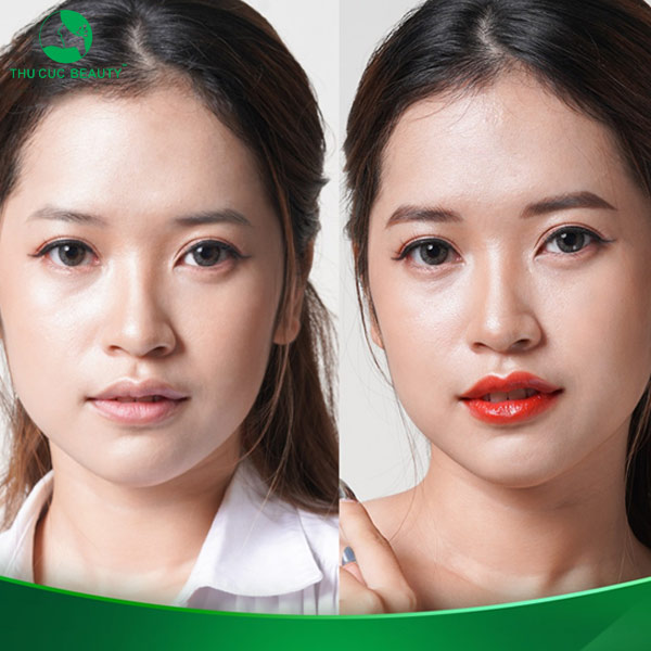 Hình minh họa kết quả phun môi thẩm mỹ