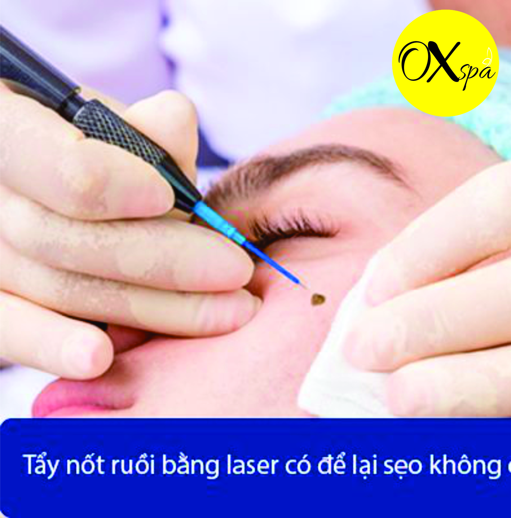 OXspa Thủ Đức xóa nốt ruồi bằng laser