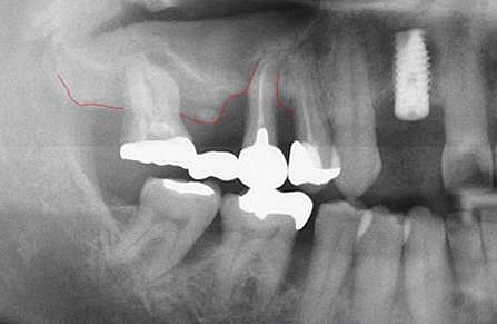 Hình ảnh cấy ghép Implant tại Nha Khoa Minh Khai