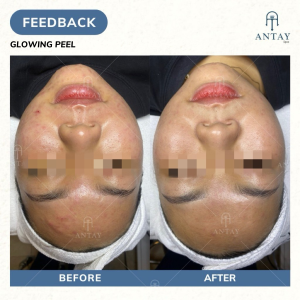 Địa chỉ peel da Tân Bình AnTay Spa - liệu trình peel da