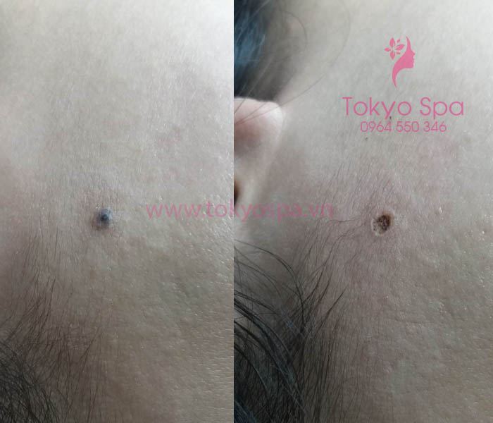 Tokyo Spa - dịch vụ tẩy xóa nốt ruồi tại Tân Phú
