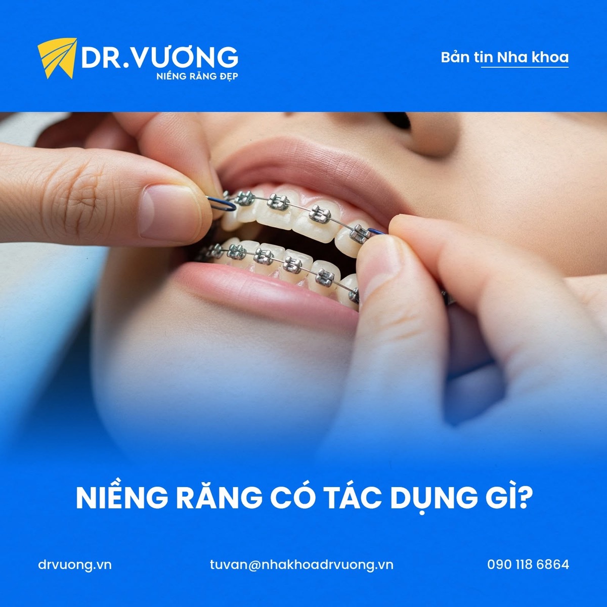 Niềng răng mắc cài kim loại tại Nha khoa Dr. Vương Thủ Đức