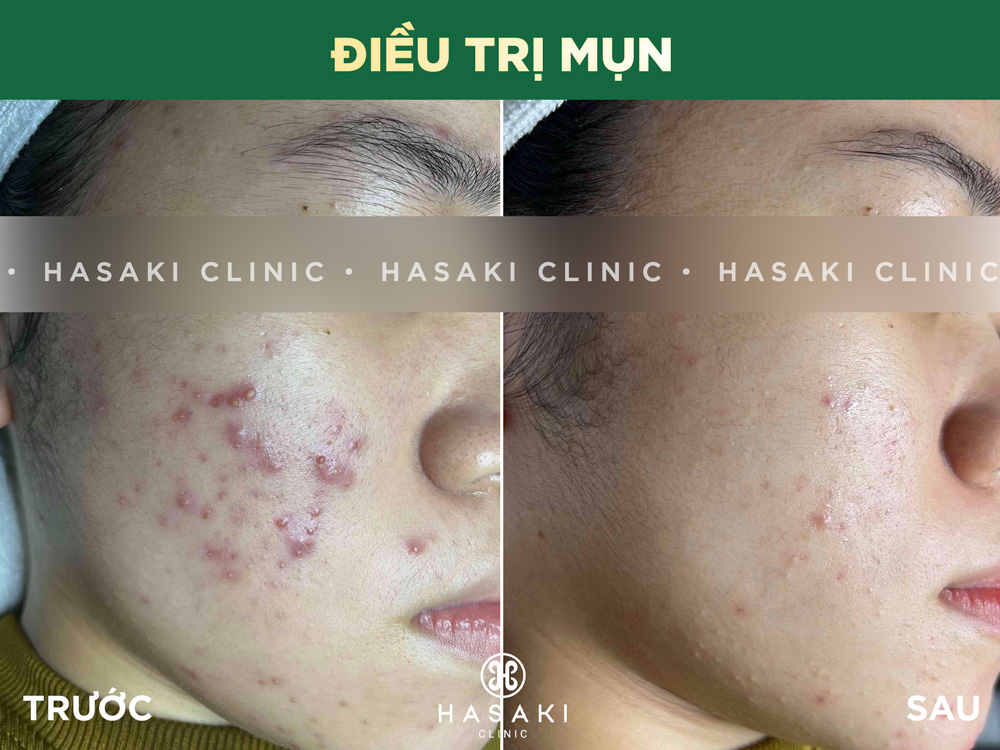 Hasaki Clinic Quận 9 - chăm sóc và điều trị da