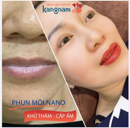 Hình ảnh dịch vụ phun môi tại Bệnh viện thẩm mỹ Kangnam