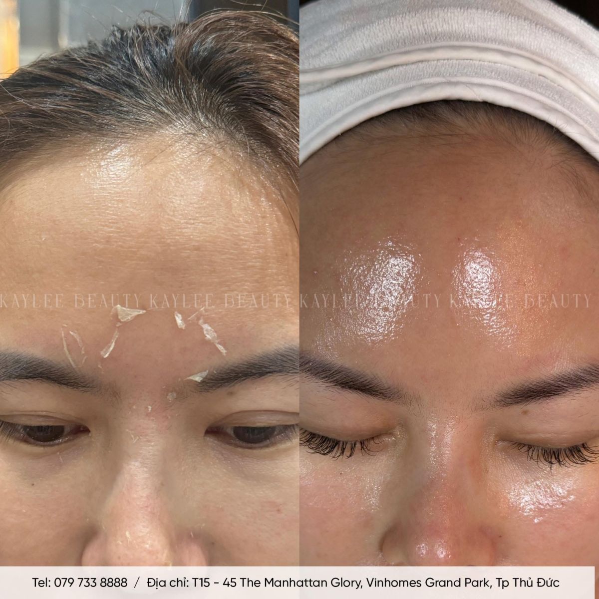 Kaylee Beauty Vinhomes Grand Park - peel da Quận 9