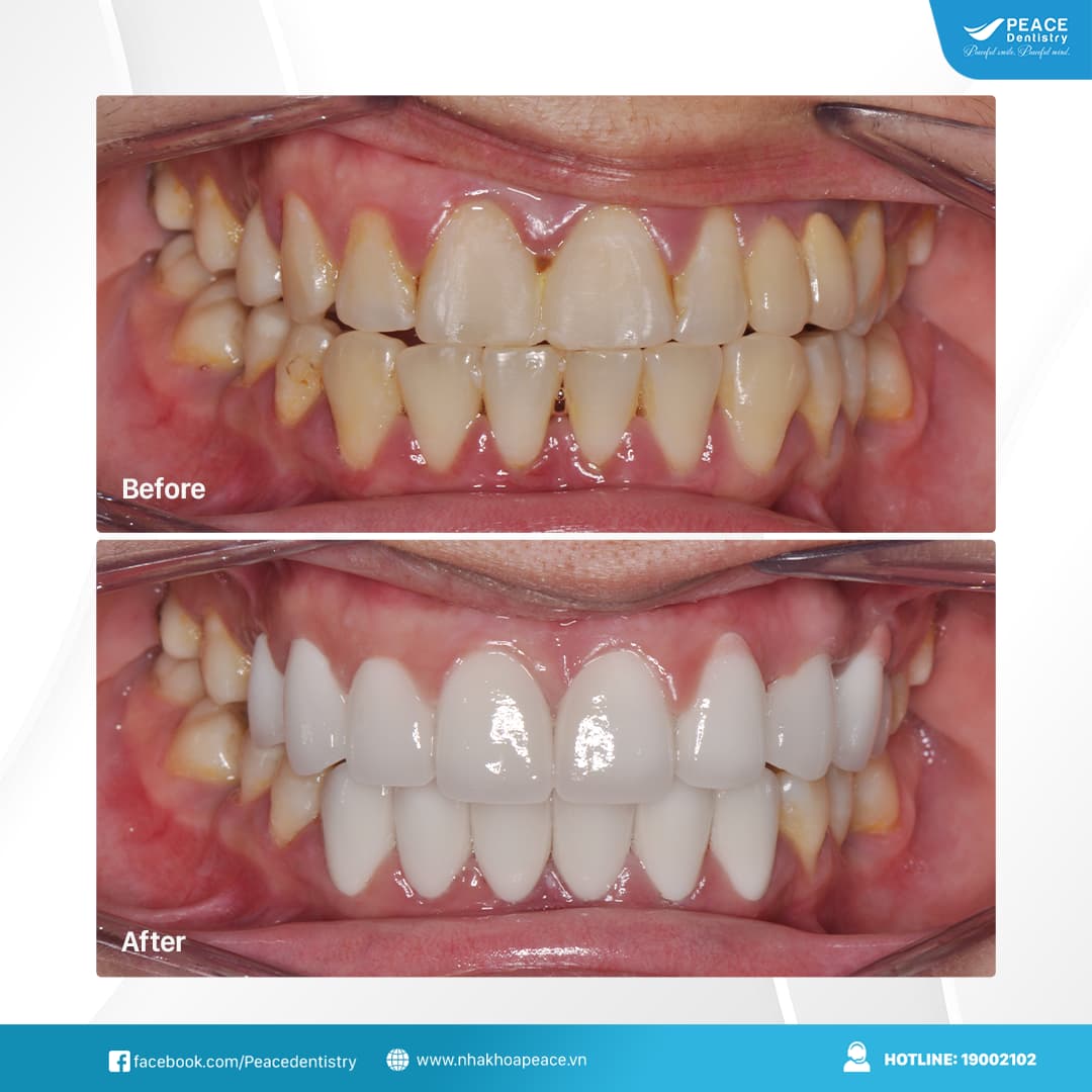 Bọc răng sứ tại Peace Dentistry Quận 7