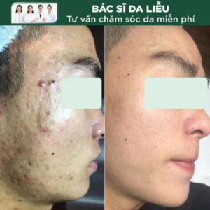 Hasaki Beauty & Clinic - spa trị mụn Quận 9