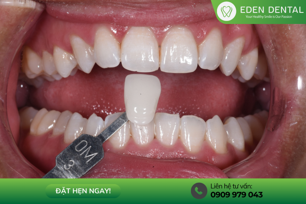 Tẩy trắng răng tại Eden Dental Quận 7