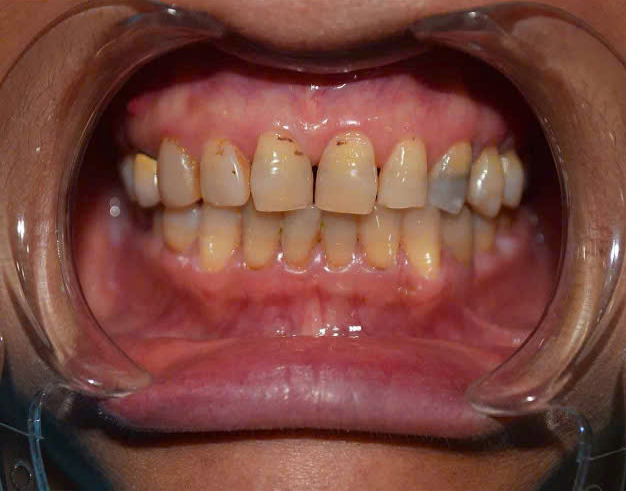 Hình ảnh lâm sàng chỉnh nha tại Nha Khoa Vạn An Prodent Thủ Đức